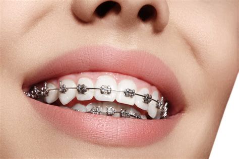 todo sobre los brackets metalicos|que es un bracket.